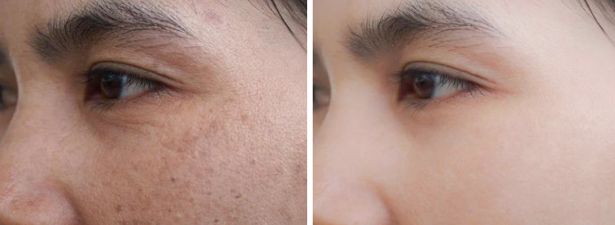 用什么方法能快速美白?