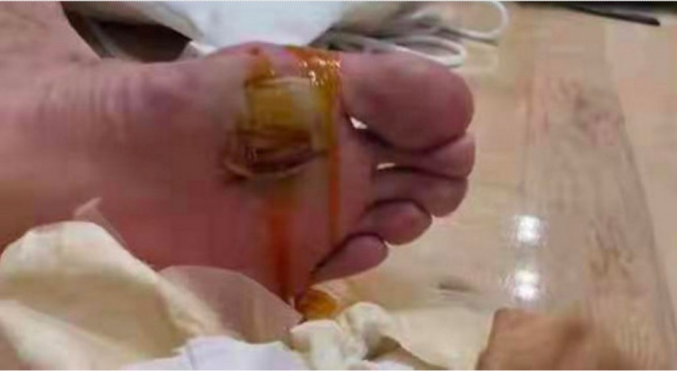 心疼!谌龙的脚上从小组赛就有小泡 打到最后已成了大血泡