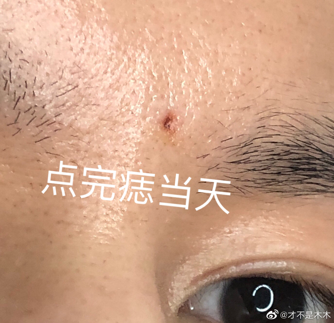 半年前的今天我去医院点了眉心痣