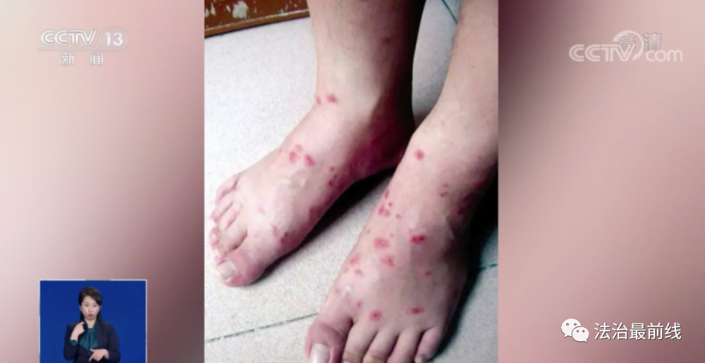 被蚂蚁咬伤广西一女子丢了性命看到这种小红土堆躲远点