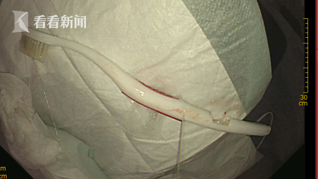 视频｜男子清洗舌苔 一不小心18厘米长牙刷“吞”下肚休闲区蓝鸢梦想 - Www.slyday.coM