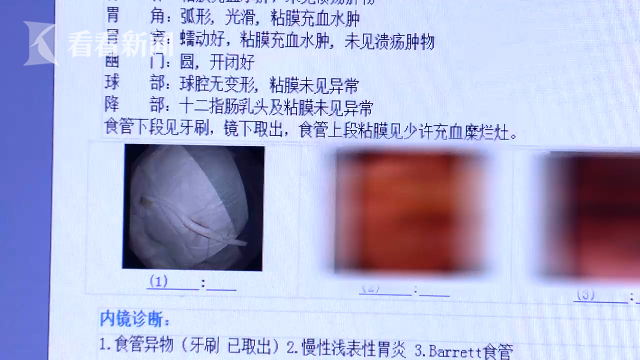 视频｜男子清洗舌苔 一不小心18厘米长牙刷“吞”下肚休闲区蓝鸢梦想 - Www.slyday.coM