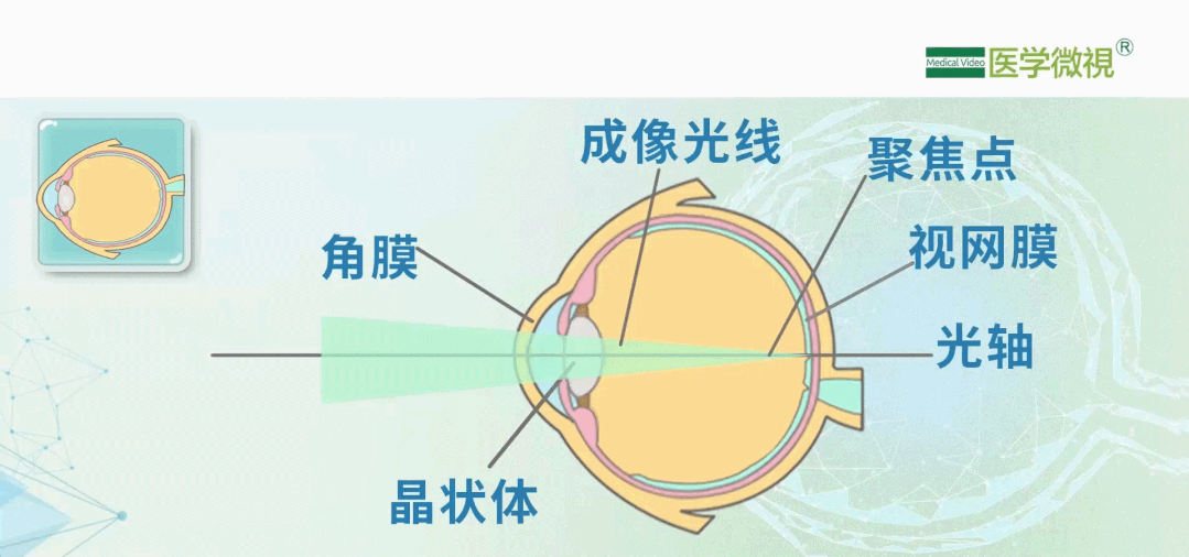 高度近视大多都有眼球前后径的增大,近视度数越高眼轴就越长,视网膜也