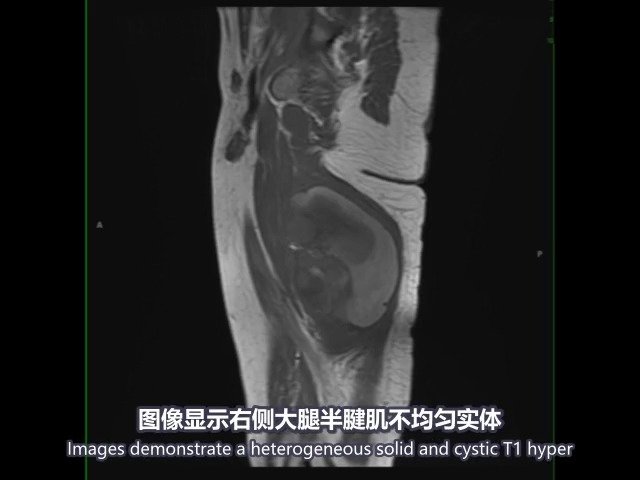 医学双语课程:大腿滑膜肉瘤 synol sarcoma