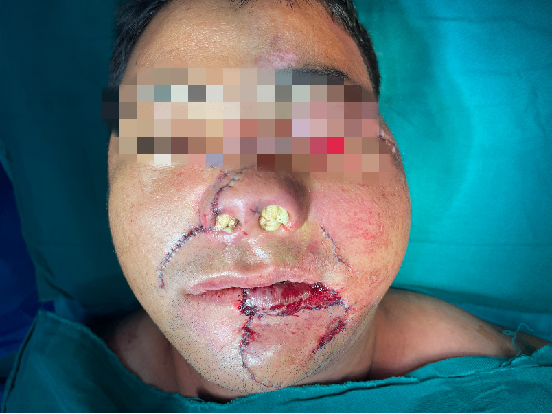 警示丨宁夏男子骑摩托翻车面部严重毁损下唇几乎脱落