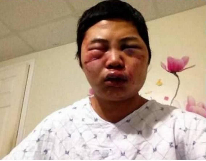 图三:可是在整个过程中,男子也被马蜂们蜇得整个脸都肿得老高.