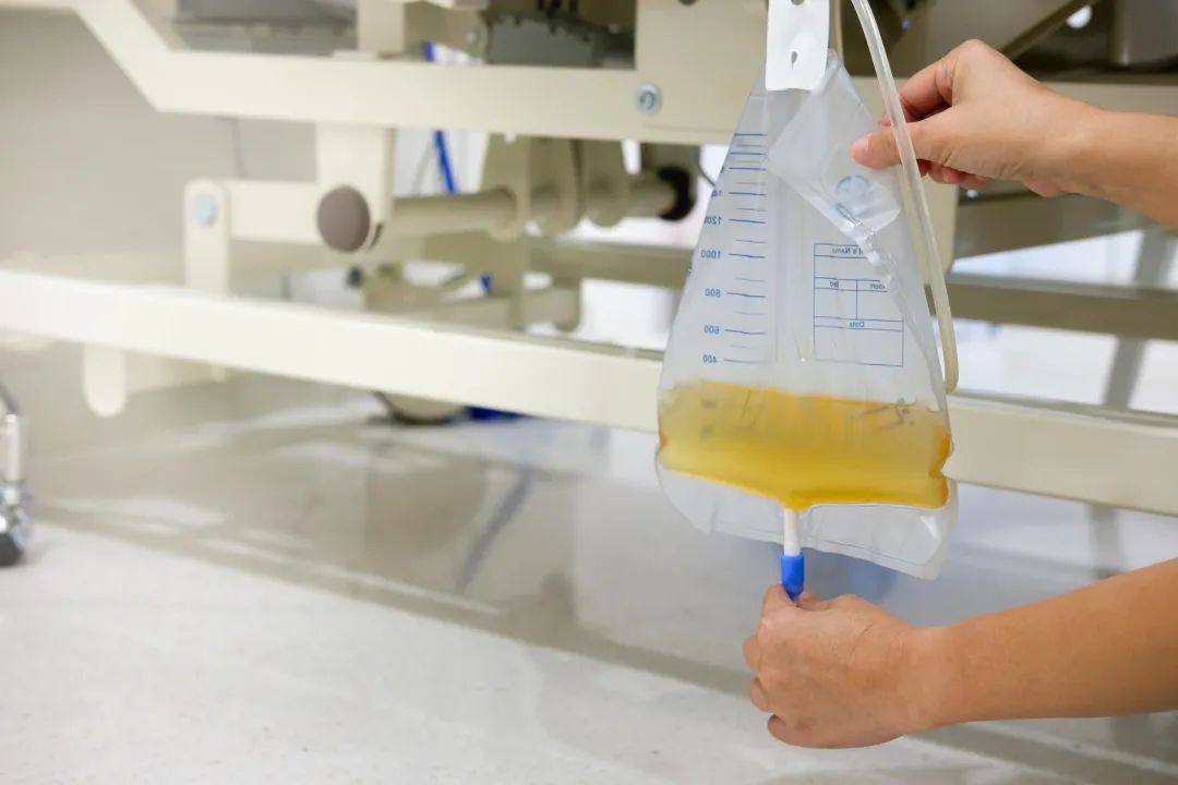 走的时候,护士手把手教我怎么放尿袋里的尿,怎么把它在我的大腿上固定