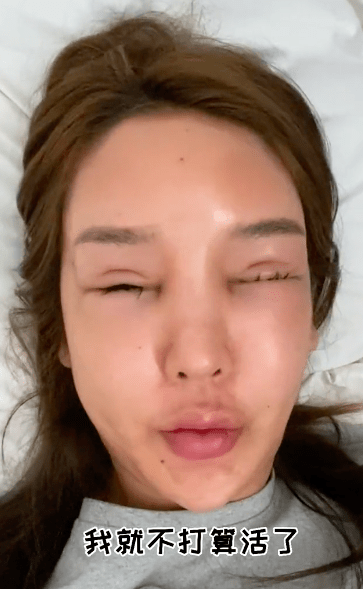 女网红整容额头变畸形溶解玻尿酸引发细菌感染晒照警醒网友