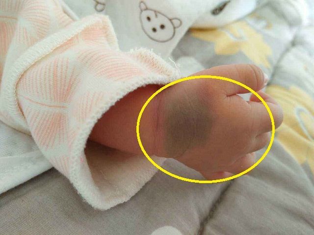 为何有些新生儿会有胎记可能跟孕妇的习惯有关要管住自己