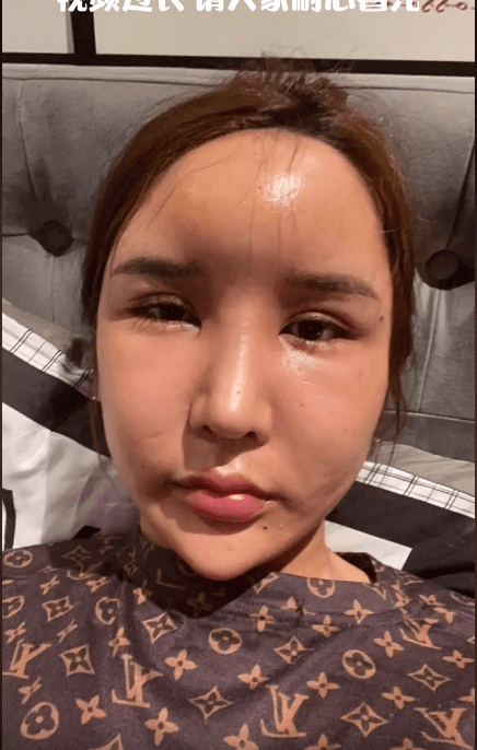 女网红整容额头变畸形溶解玻尿酸引发细菌感染晒照警醒网友