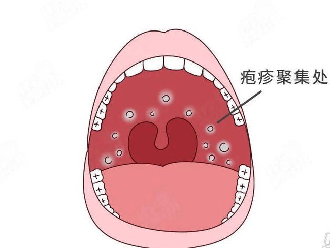 小兒推拿楊曉皰疹性咽峽炎進入高發期如何識別護理及預防