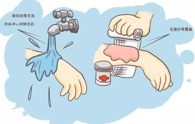 关于烫伤处理,牢记这几点!