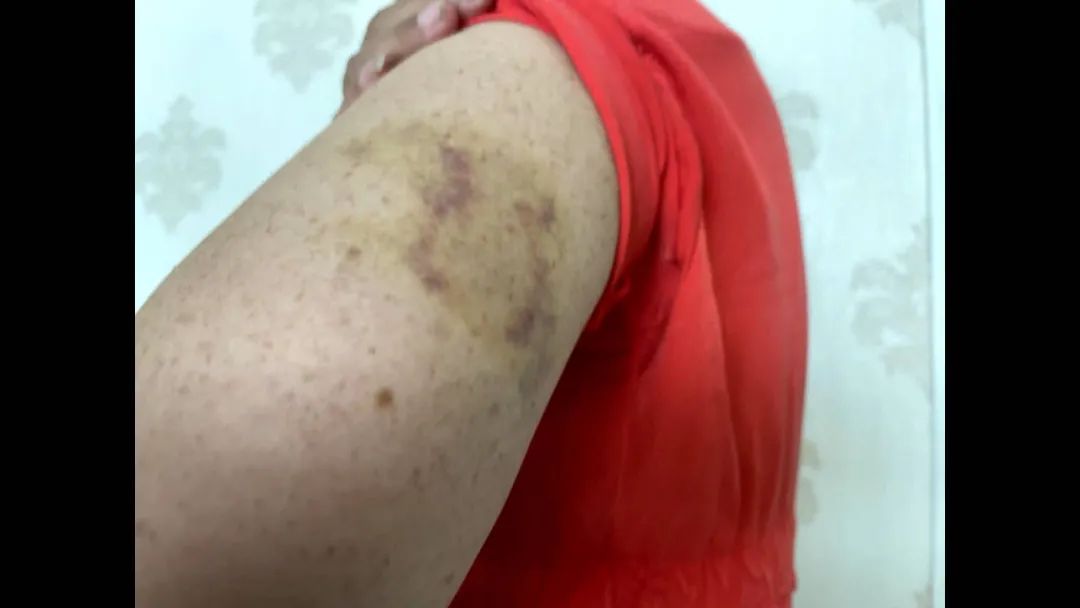 惊丨银川一老人在小区被泰迪两次扑咬胳膊手背受伤