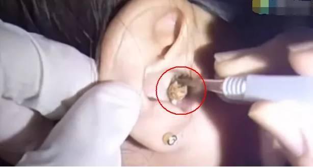 女子十几年没掏耳朵,感觉不对劲,去医院拿出来的东西让人惊讶