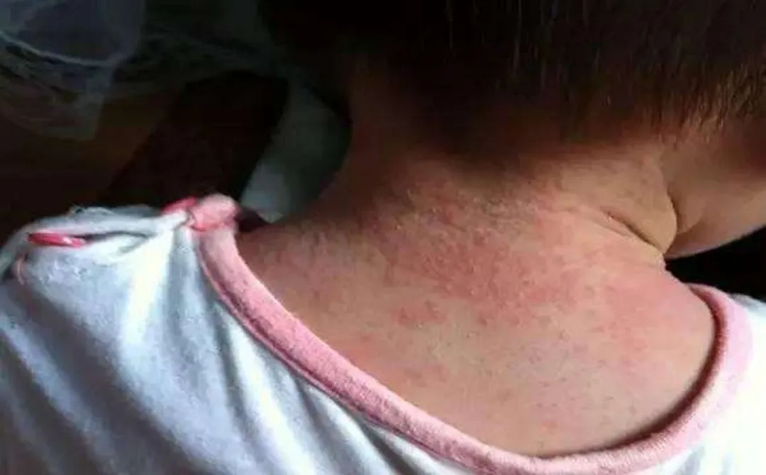 根据汗管阻塞位置的不同,痱子可以分为红痱,白痱,脓痱和深痱.