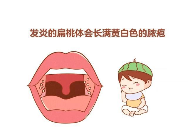 小儿推拿杨晓儿童扁桃体反复发炎需不需要切除如何治疗预防