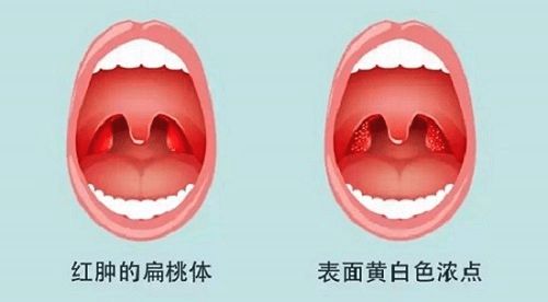 小儿推拿杨晓儿童扁桃体反复发炎需不需要切除如何治疗预防
