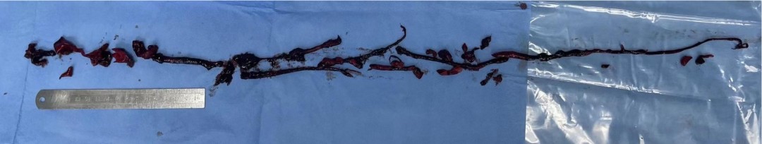 罕见！女子体内取出1米长血栓！病因居然是心房颤动休闲区蓝鸢梦想 - Www.slyday.coM