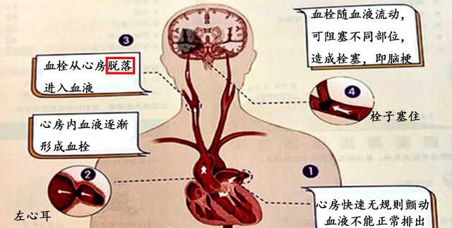 脑血栓|脑栓塞|水管_新浪新闻