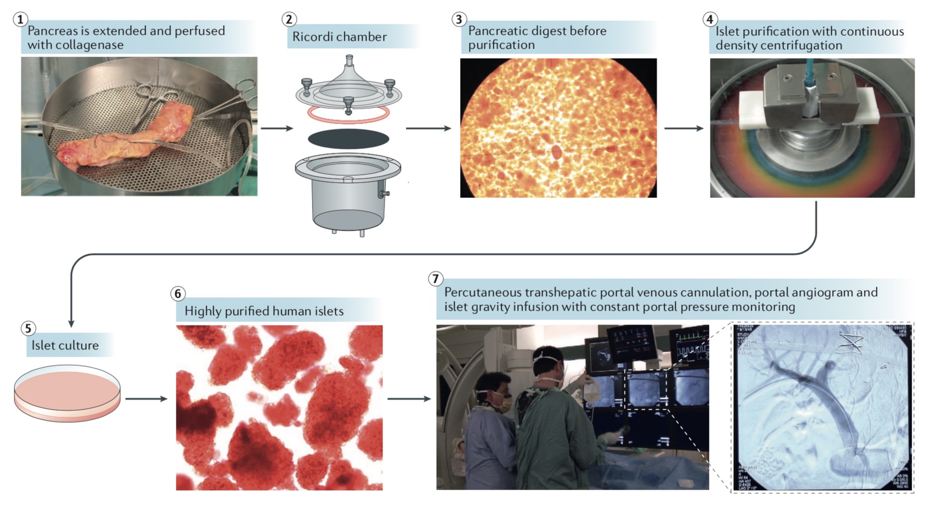 胰岛分离至胰岛移植全流程概图。图片来源：James Shapiro等人论文"Clinical pancreatic islet transplantation"