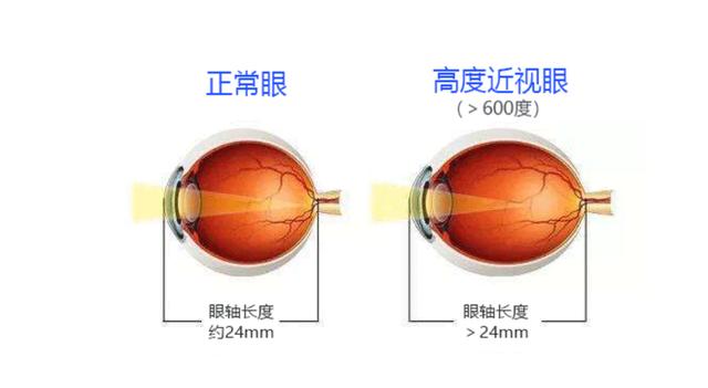 眼科医院院长王铮教授介绍,高度近视会导致眼球结构发生很大的变化