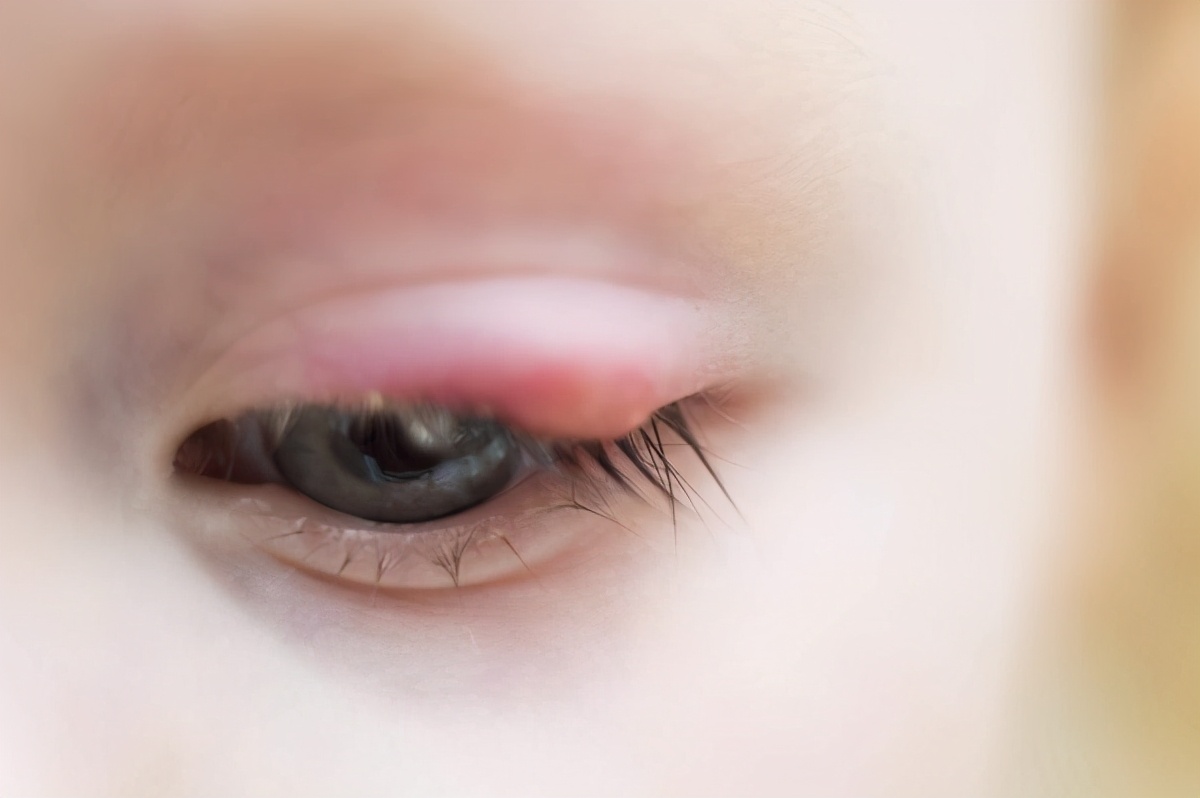 可能是2种疾病作怪,保护眼睛还得用好老四招|红肿|麦粒肿|结膜炎_新浪