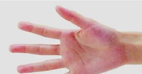 男子查出肝癌,身体出现"2臭3痛4红",检查一下肝脏