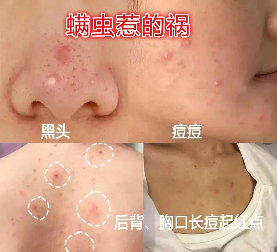 时间一长,毛囊,皮脂腺毁坏,毛孔弹性变差,出油多,黑头,粉刺,痘痘纷纷