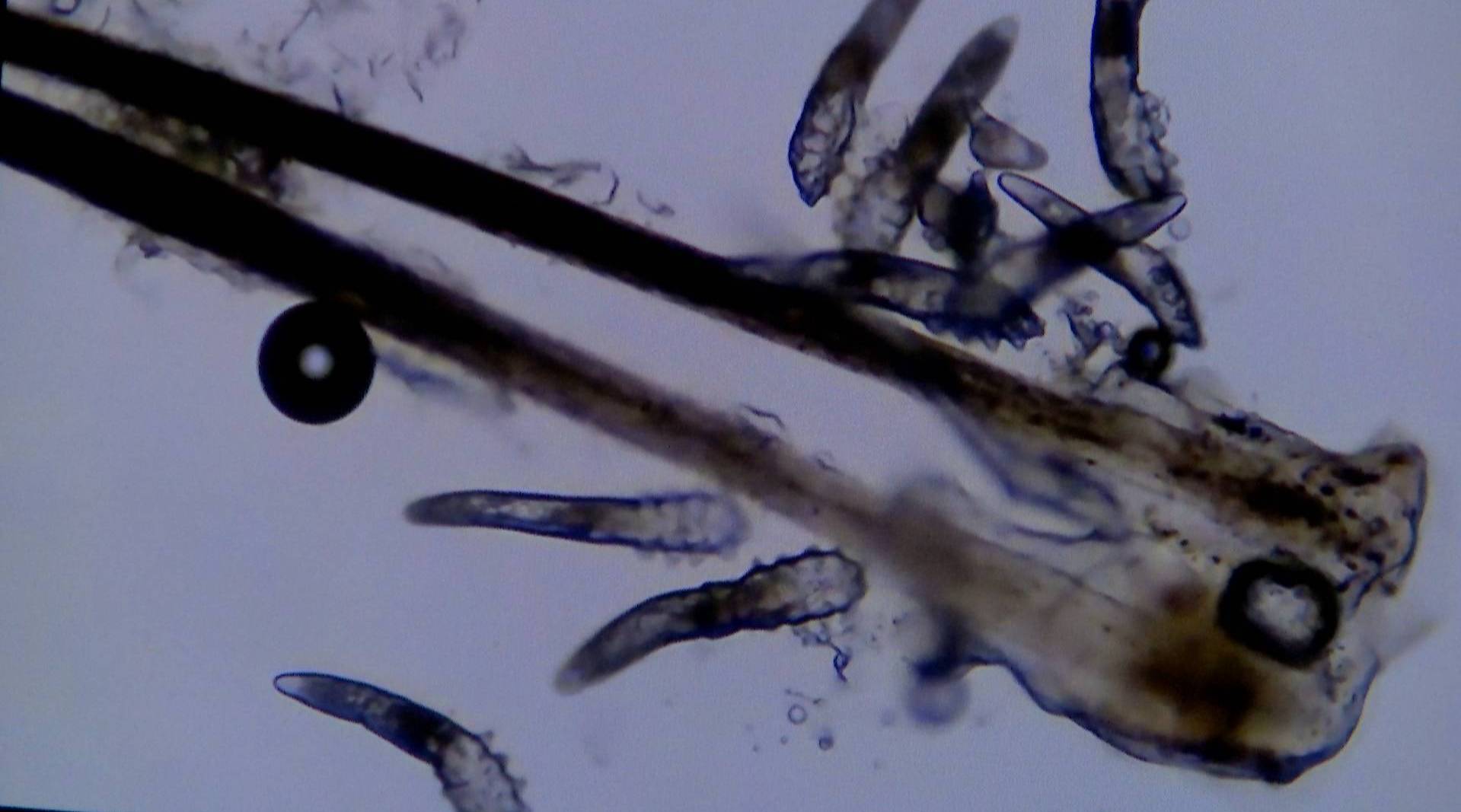 女子睫毛里发现近十条螨虫