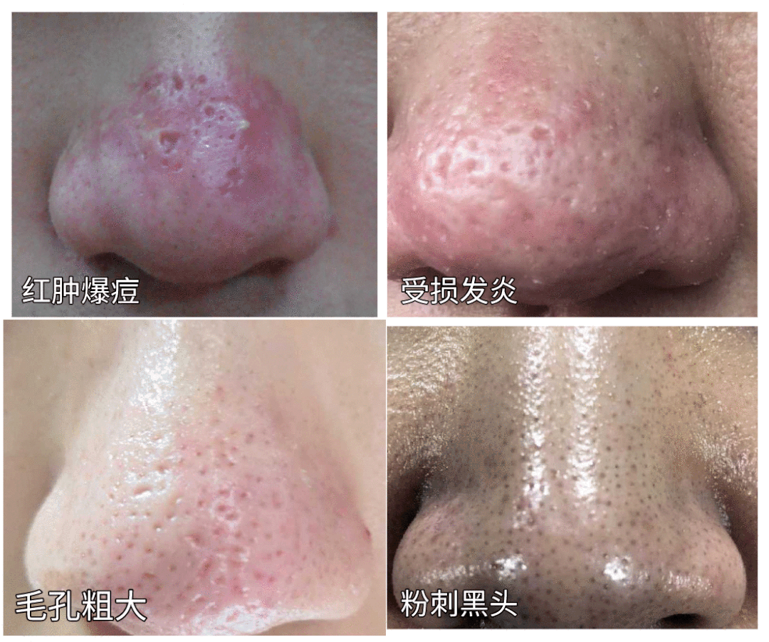 别再用手挤黑头了教你一招在家轻松去黑头