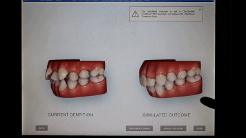 △iTero牙齿矫正黑科技 可以提前预知牙齿矫正后的效果