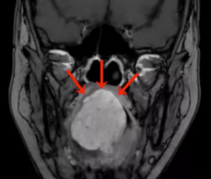 女子做核酸检测意外查出舌根癌，这些症状要注意！休闲区蓝鸢梦想 - Www.slyday.coM