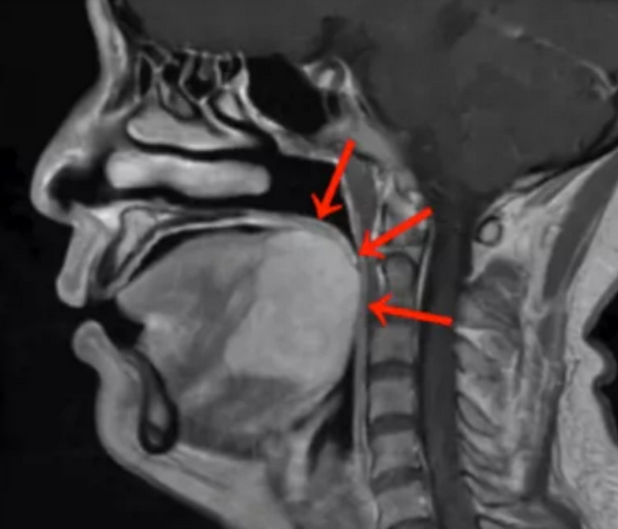 女子做核酸检测意外查出舌根癌，这些症状要注意！休闲区蓝鸢梦想 - Www.slyday.coM