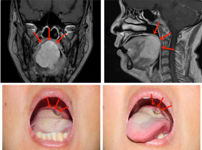 女子做核酸检测，意外发现舌根隐藏巨大肿块，竟是…休闲区蓝鸢梦想 - Www.slyday.coM