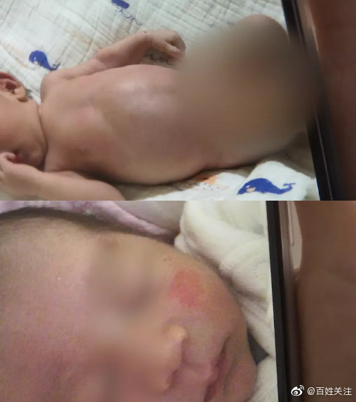 家长称月嫂不专业致婴儿皮肤受损：长了湿疹却说不需要擦药休闲区蓝鸢梦想 - Www.slyday.coM