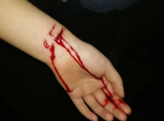 患者用苹果核割腕!护士"火眼金睛"及时发现化解危机