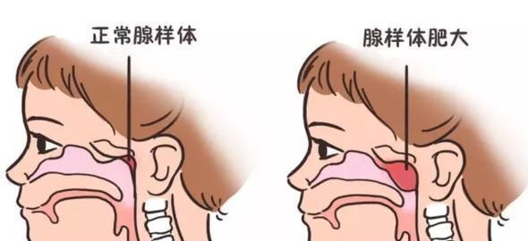 长期张口呼吸可能导致孩子变丑