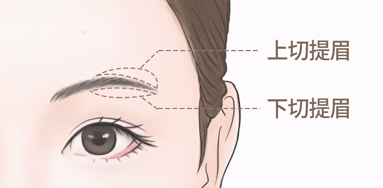 杭州美莱7周年庆 | 做提眉术有哪些效果