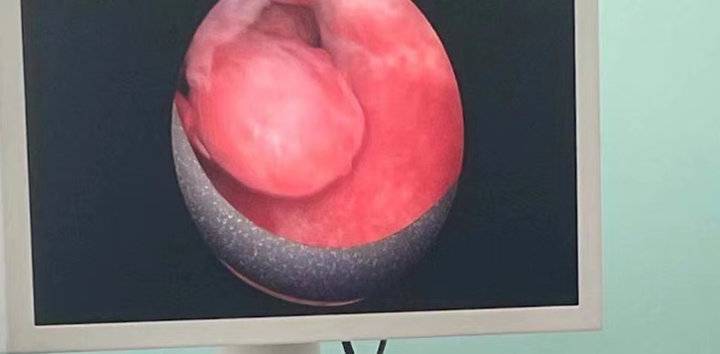 月经不正常,警惕子宫内膜息肉