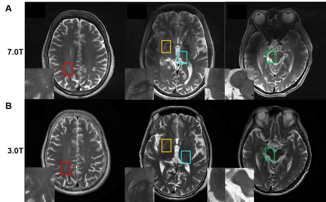 Aging 浙大赖欣怡 吕文团队揭示血管周间隙负荷改变在帕金森病的作用 浙江大学 新浪新闻