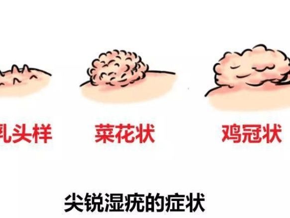 脖子上的小揪揪别拔,当心是hpv感染,越拔越多|丝状疣|尖锐湿疣|病毒