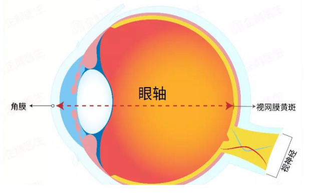 眼轴长近视防控