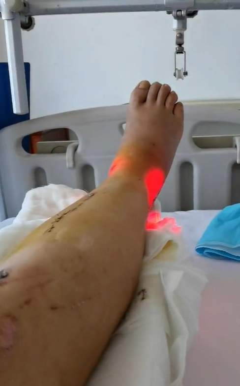 老戏骨张春年坐轮椅出院骑摩托翻车摔断腿小腿皮肤伤疤太明显