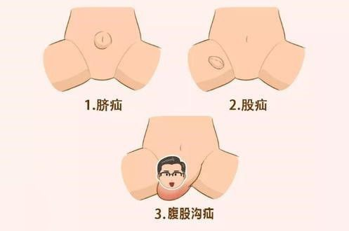 健康随行丨勿以"疝"小而不为|疝气|健康随行_新浪新闻