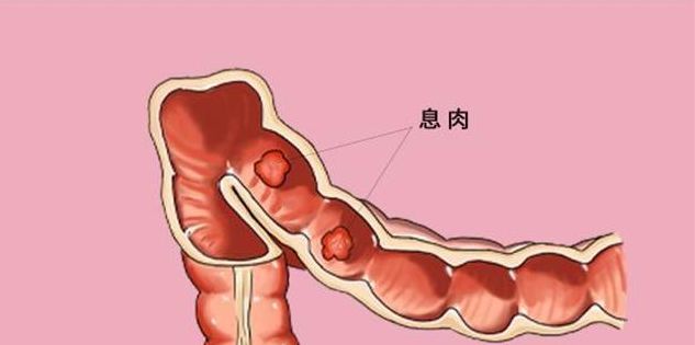 結腸息肉手術怎麼做|結腸息肉|手術|患者_新浪新聞