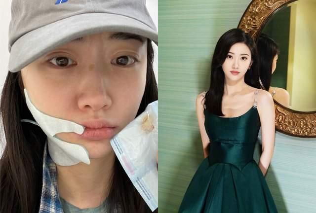 33岁景甜拔牙后晒素颜照嘴唇干裂表情委屈脸肿仍然不惧出镜