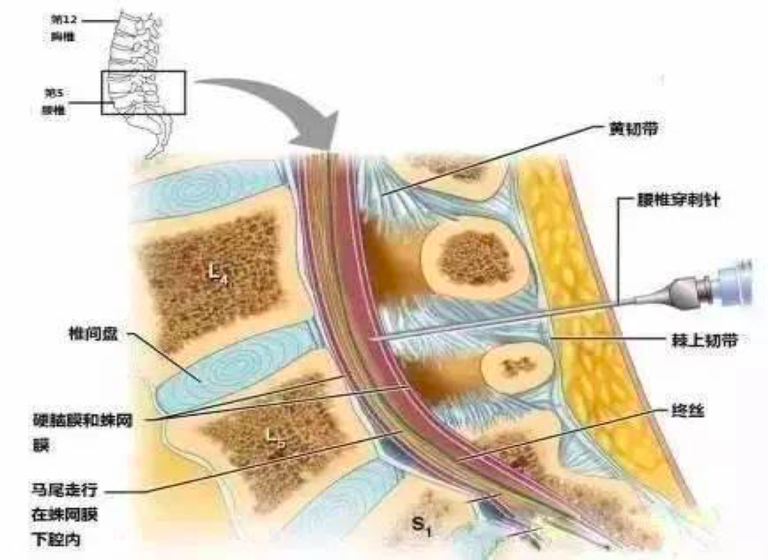 您的孩子做腰穿了吗一文说清腰椎穿刺