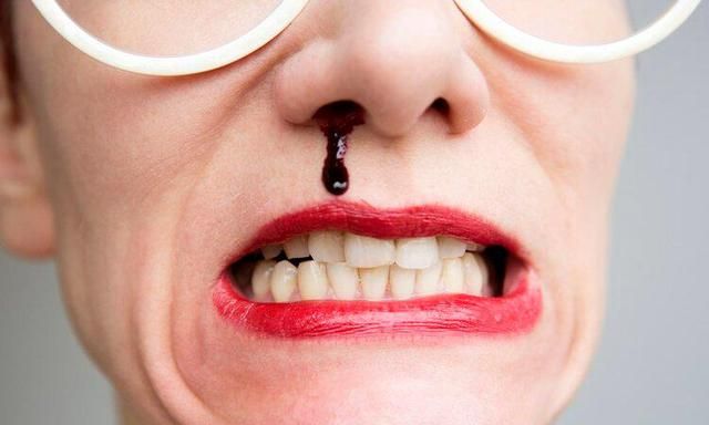 再次告诫流鼻血不需害怕用这2个方法就行了不是仰头