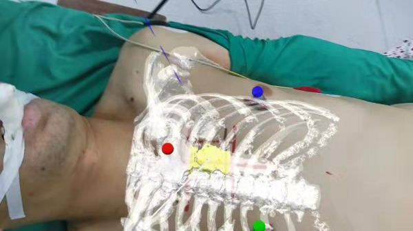 如何留住2厘米胸骨柄？长征医院在手术中用了混合现实技术休闲区蓝鸢梦想 - Www.slyday.coM