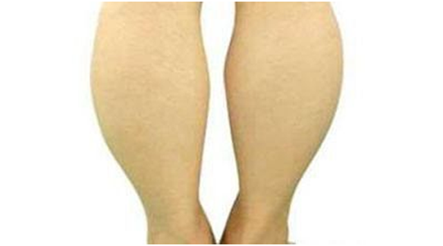 小腿吸脂 | 小腿粗成这样怎么办?